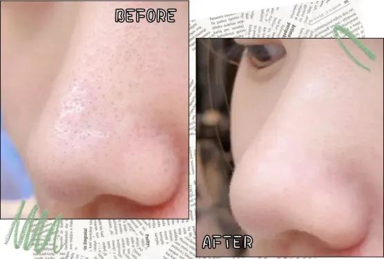 深度清理毛孔黑头教程,清洁毛孔里的黑头和白头小妙招