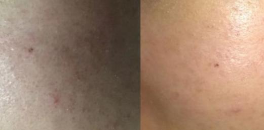 干粉祛痘,冰冻干粉可以祛痘吗