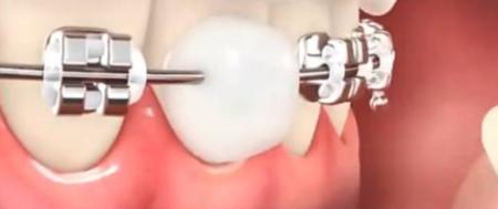 矫正牙齿钢线越来越长扎嘴,牙齿矫正嘴型变美