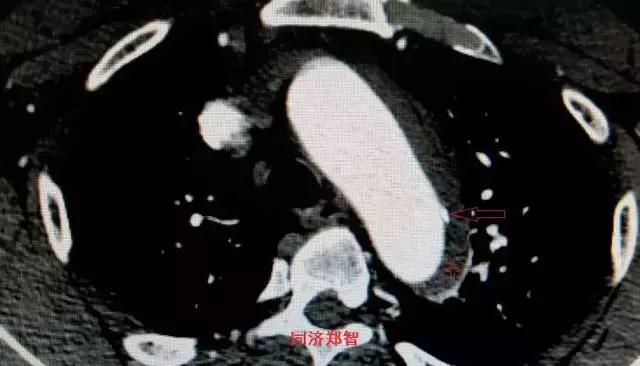 磁共振可以替代cta检查主动脉夹层,主动脉夹层cta上如何分辨真假腔