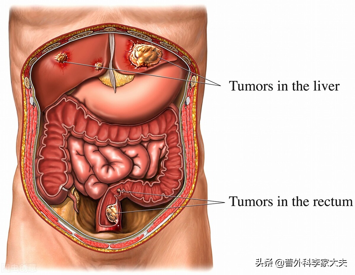 直肠癌手术后吃什么营养恢复更快,直肠癌有什么症状和表现