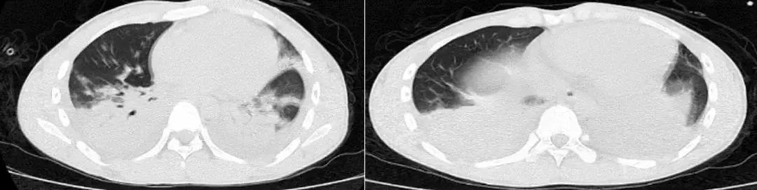 抗菌药物不合理处方分析,抗菌药物用药不合理的表现