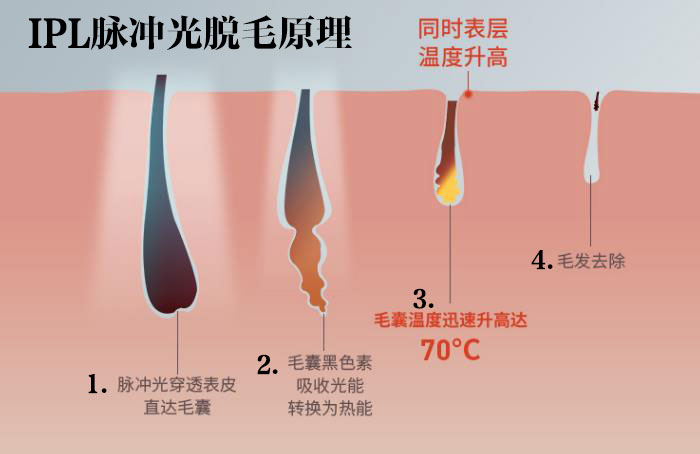 罗永浩脱毛仪讲解,罗永浩激光脱毛器