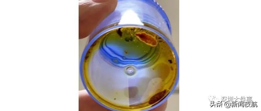 一名女子体内取出3000多颗胆结石,胆结石取出活虫