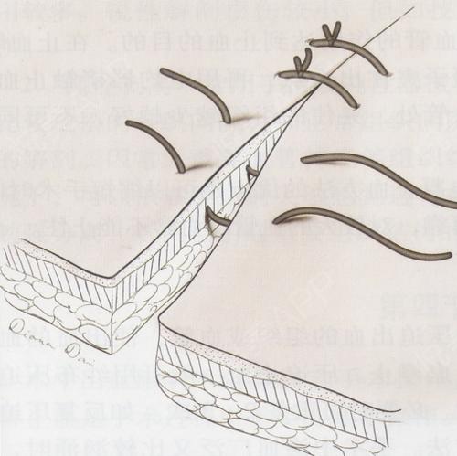 免拆线伤口的护理,切眼袋拆线后的伤口怎么护理