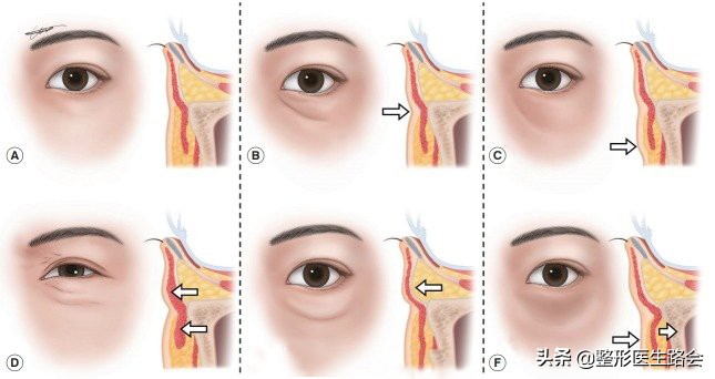 注射泪沟淤青一般需要几天好,胶原蛋白注射泪沟淤青多久能好