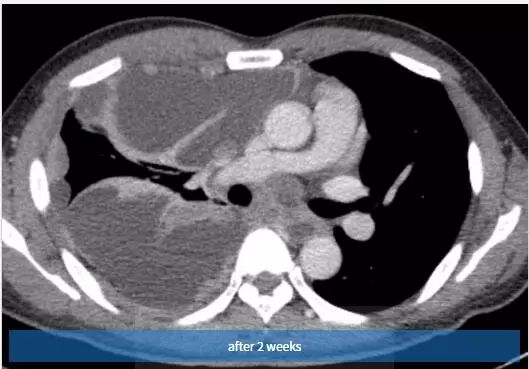 胸壁疼痛的典型特征,临床诊断胸痛是什么意思