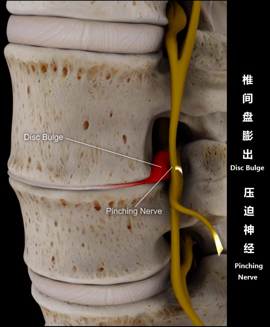 预防腰痛的正确方法,关于腰痛治疗方法有哪些