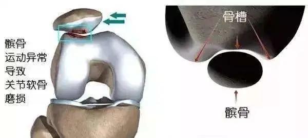 膝盖走路打软怎么回事,走路膝盖酸软是缺钙吗