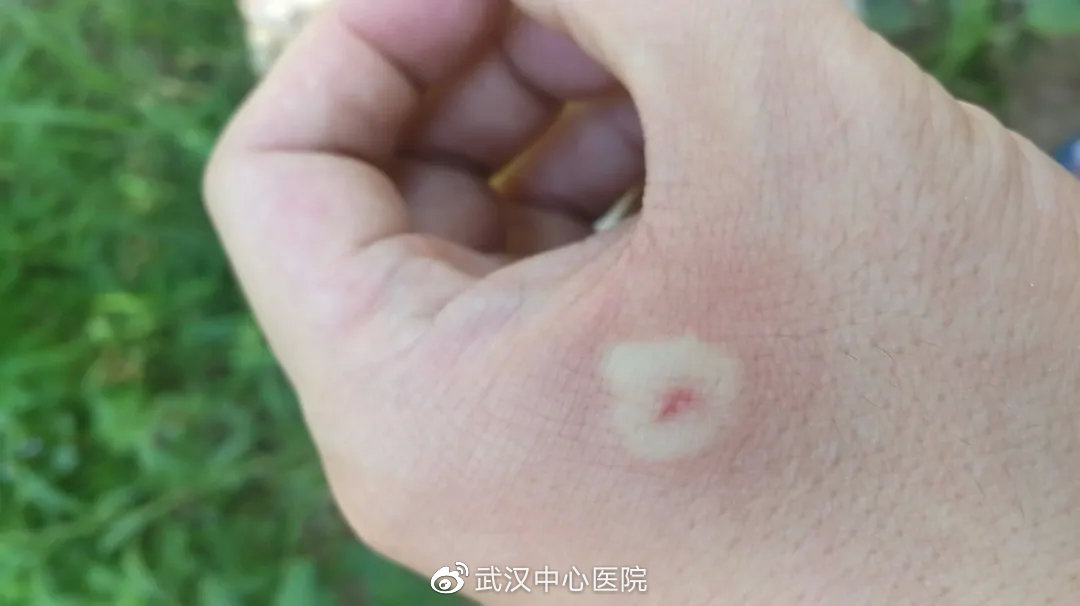 遇到这些虫子千万别拍它,提高警惕遇到这些虫子千万别乱拍