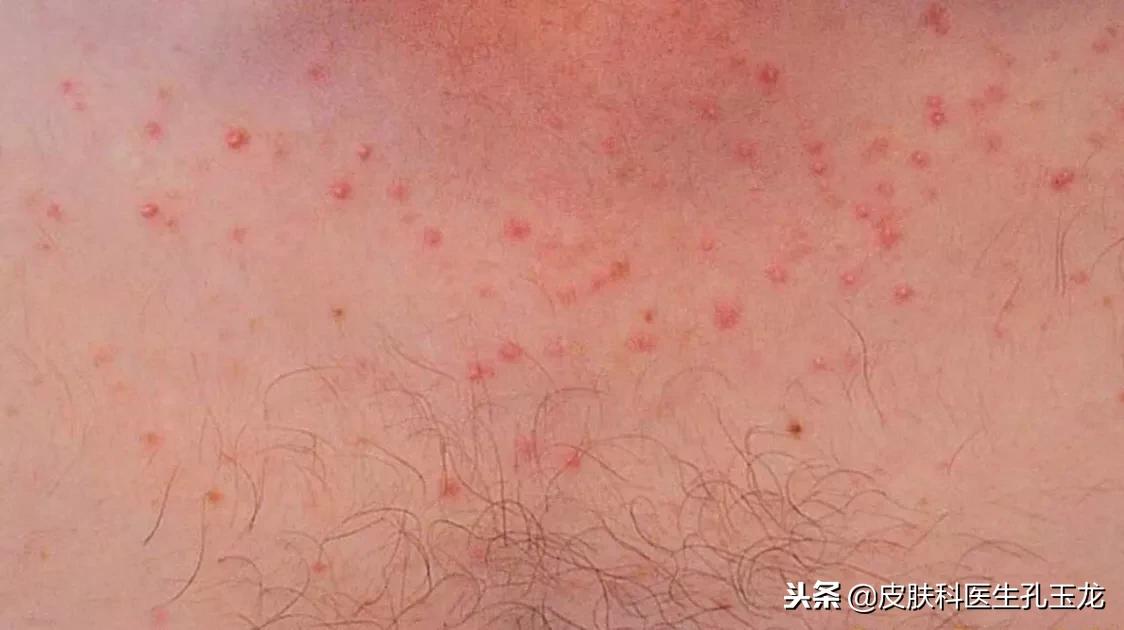 皮肤病毛囊炎,皮肤毛囊炎的原因和症状