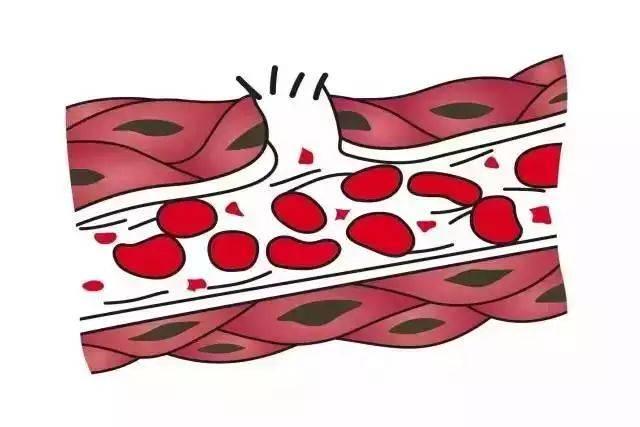 「梦里与丈夫吵架」醒来后咯血，是什么导致了她右侧支气管阻塞？