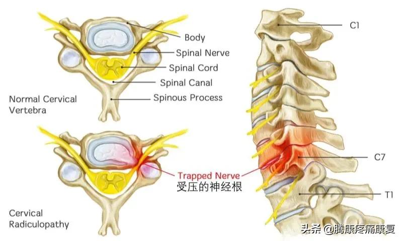 颈丛神经卡压症推拿手法,颈神经卡压的症状是什么