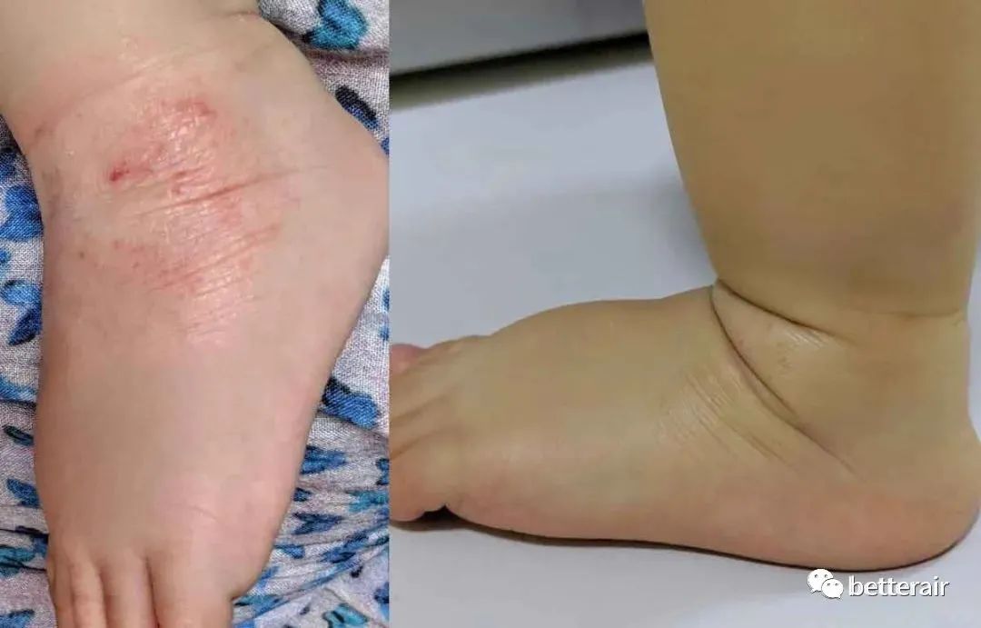 宝宝湿疹发作,痒痛到又哭又叫,直到betterair出现
