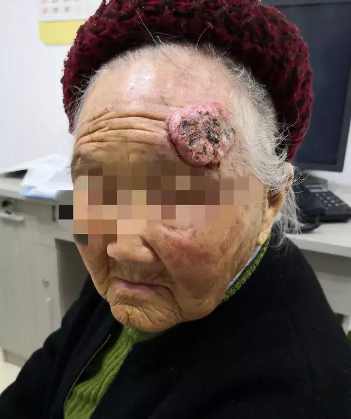 百岁老人额头长疮是怎么回事,百岁老人头有一个瘤