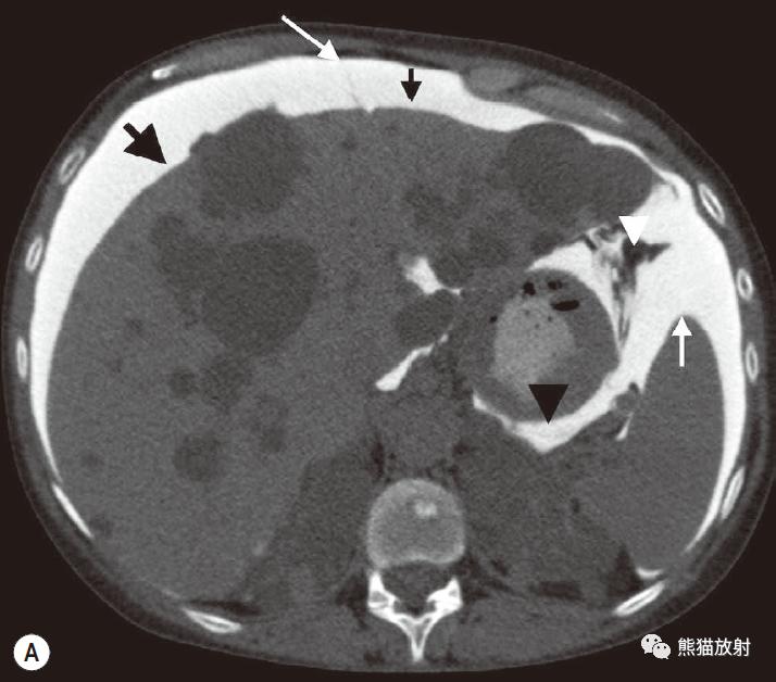肠系膜解剖图,肠系膜解剖图解