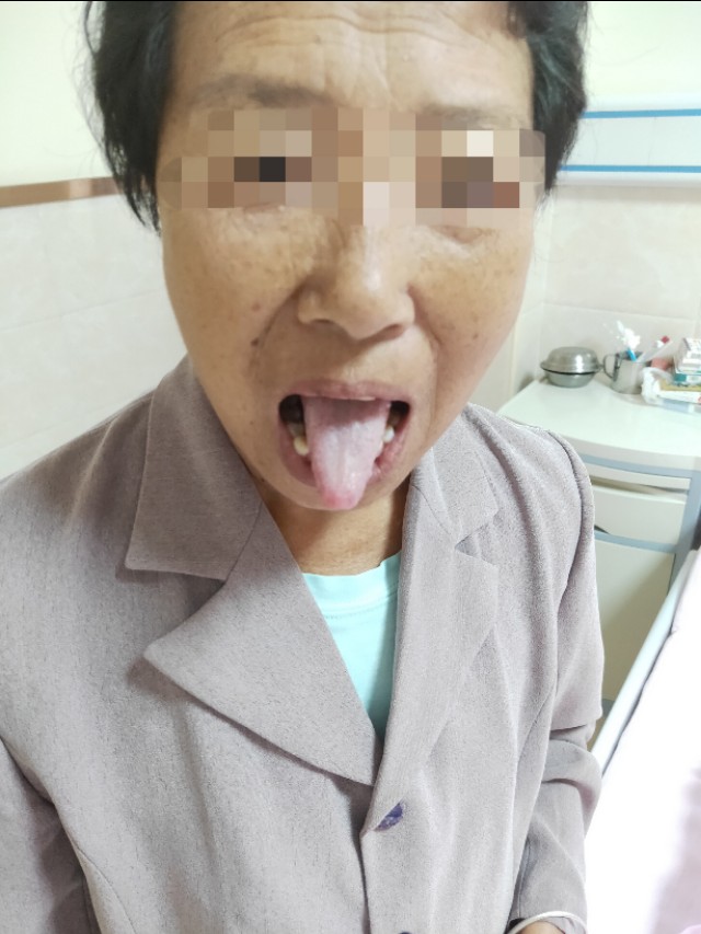 尿毒症身上痒有小疙瘩中医,尿毒症止痒外用药