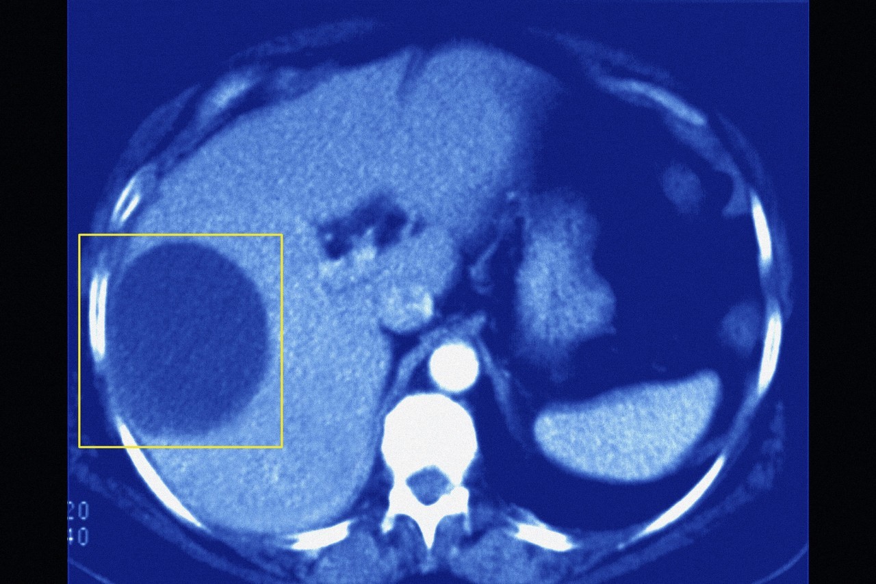 肝囊肿什么情况下要做手术呢,什么样的肝囊肿会自愈