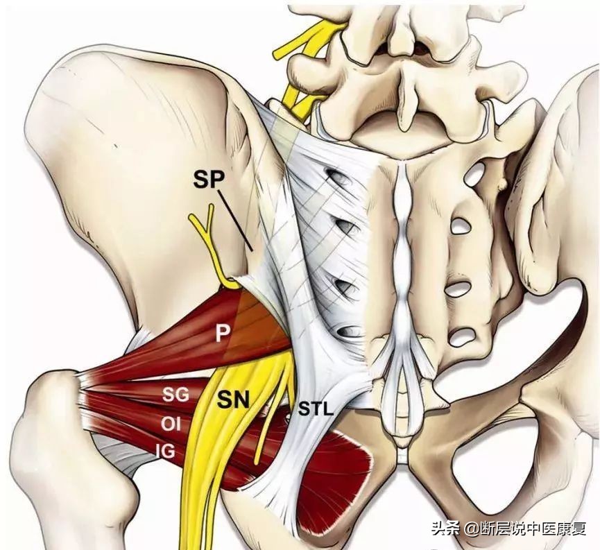 怎样才能治好梨状肌综合征,如何治疗梨状肌综合征