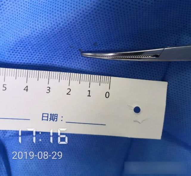 阑尾炎形成窦道的原因,阑尾炎一孔微创手术全过程