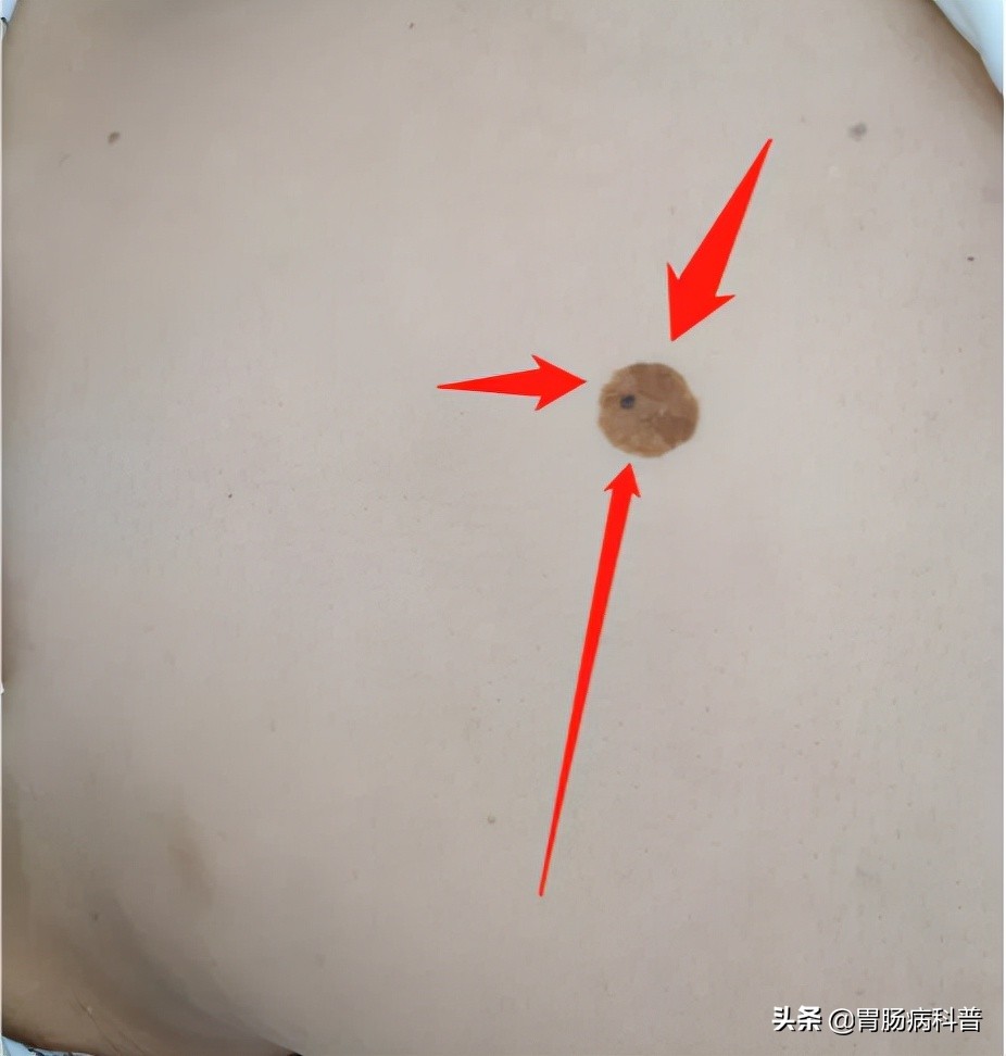 七十岁老太太腿部长了个肉疙瘩,70岁老太太患上了癌症