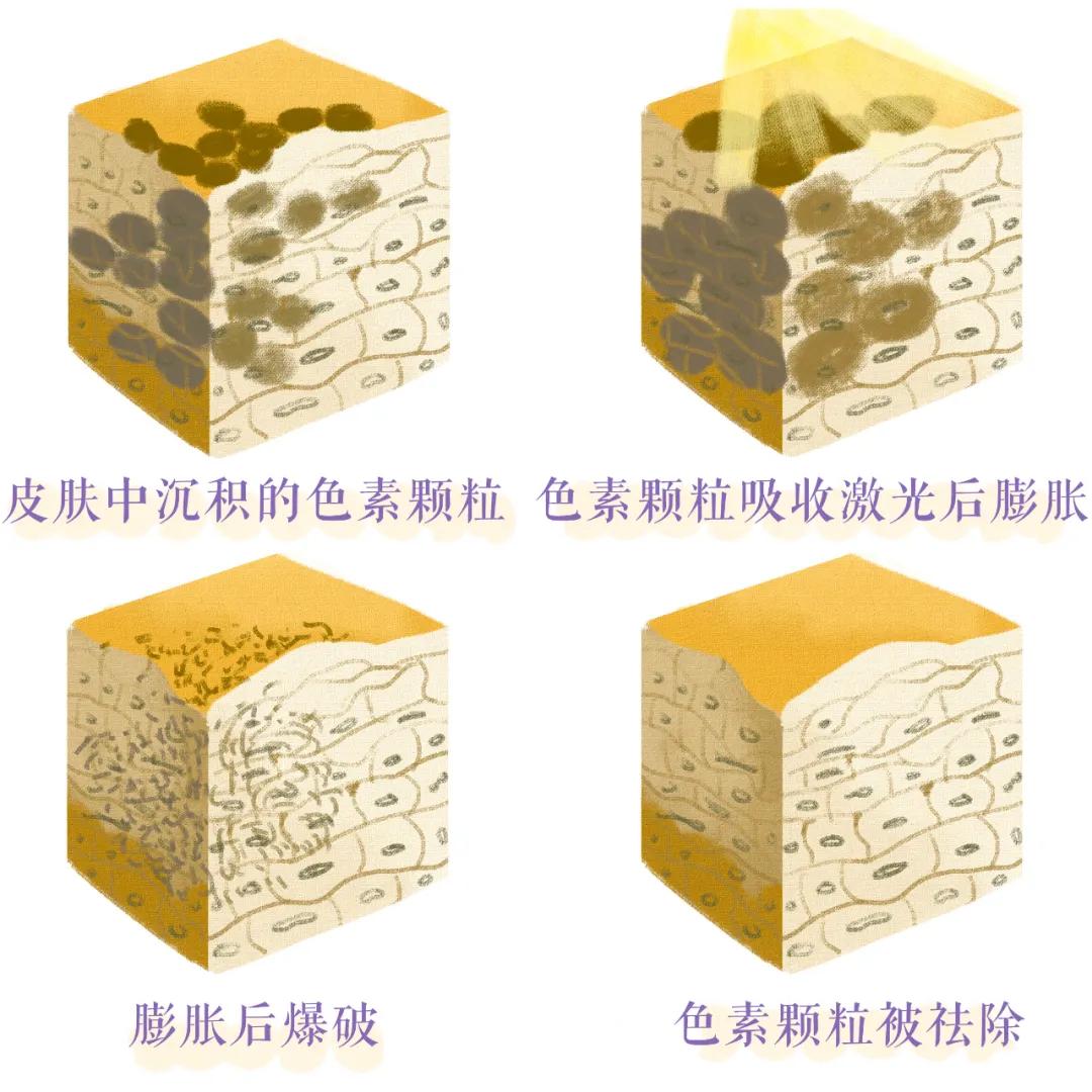 医美做什么能永远不长痘,脸很多痘坑做什么医美