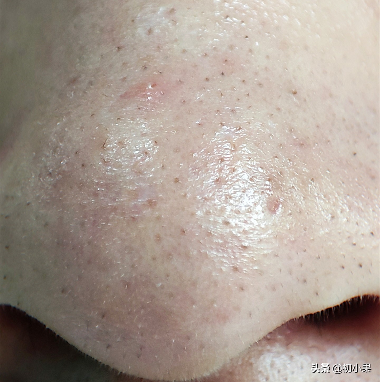 鼻子上的黑头怎么去除视频,鼻子上的黑头怎么去除效果最好