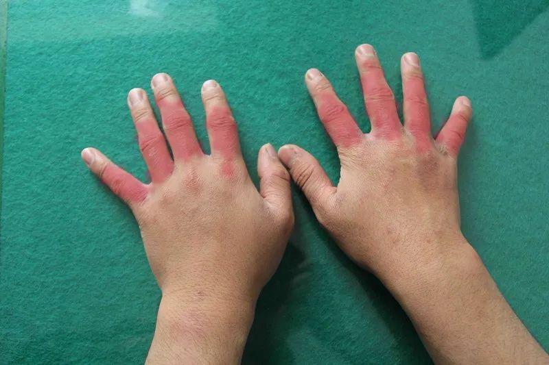 喝酒后冻死是怎么回事,喝酒第二天发冷发热是怎么回事