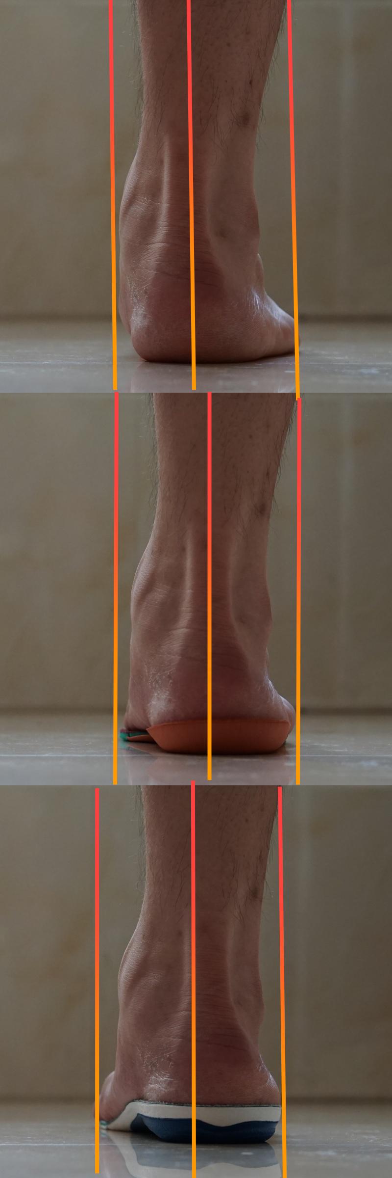 低足弓如何改善,足弓矫正鞋垫硬的好软的好