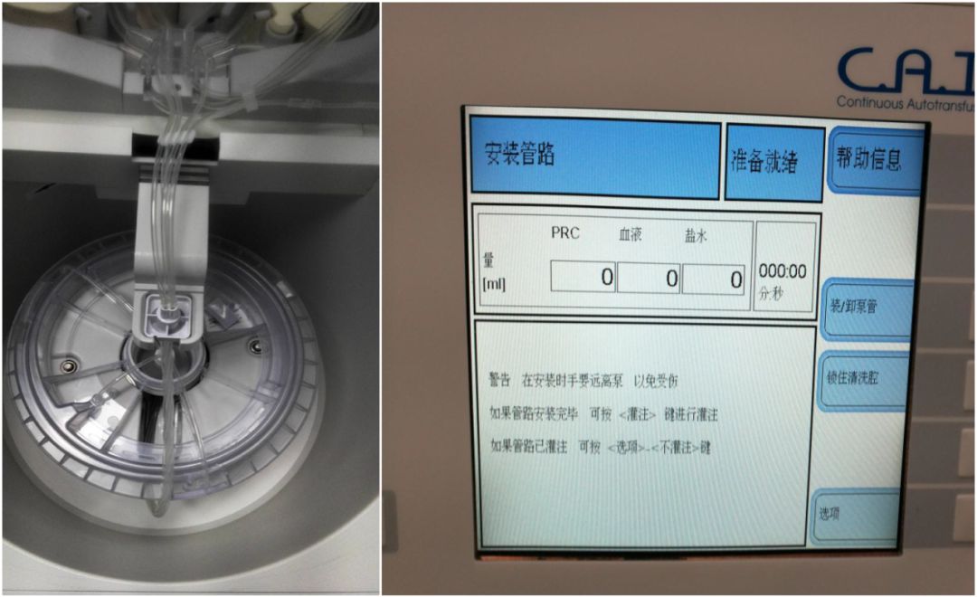 马康:术中自体血液回收