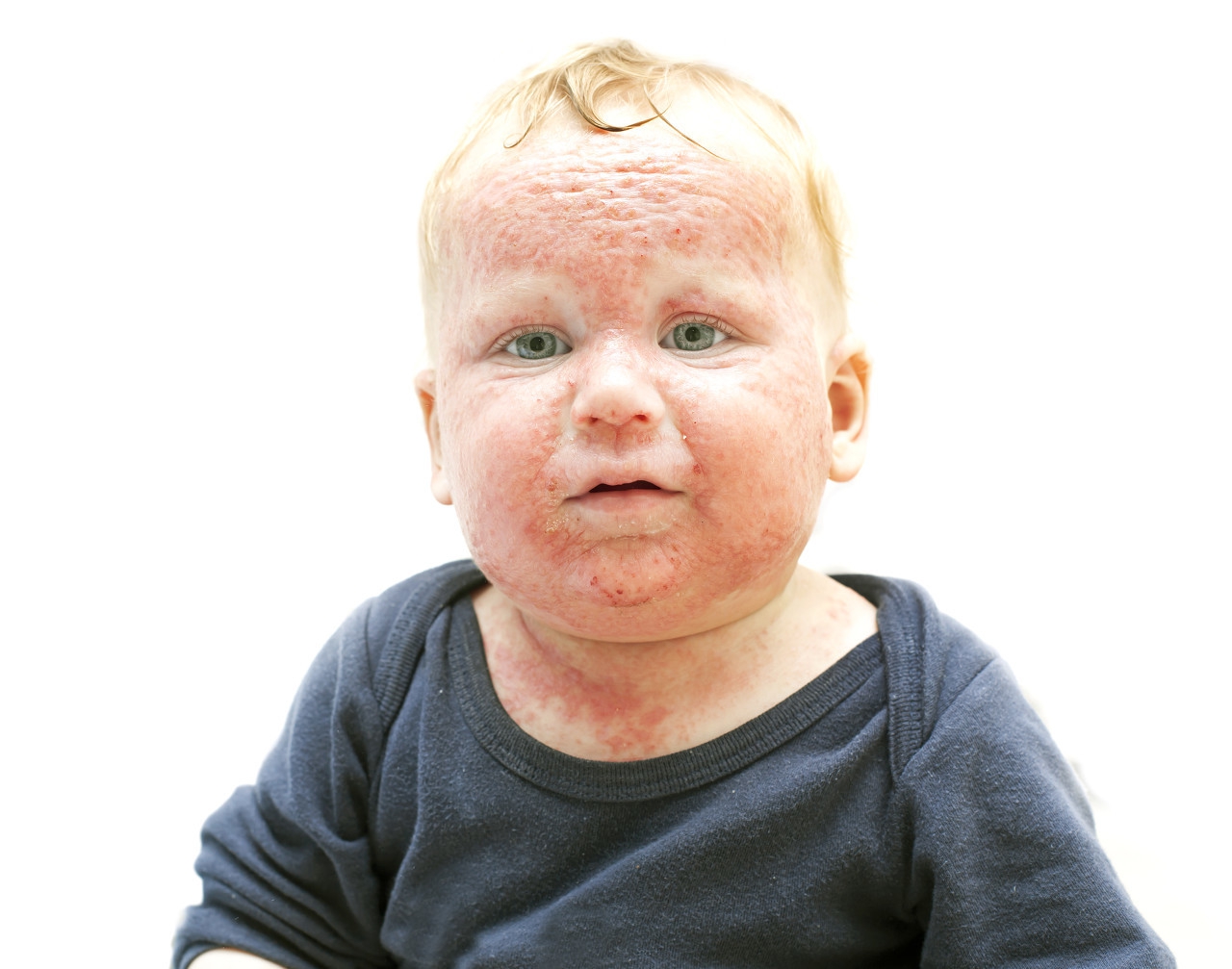 婴儿湿疹怎么预防最佳方法,宝宝湿疹的正确防治方法