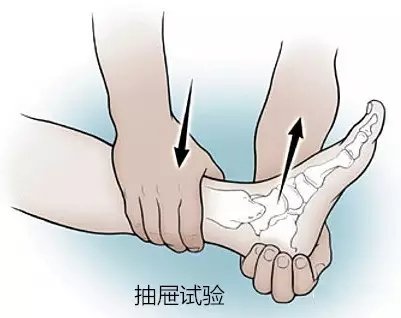 外踝韧带损伤后如何打绷带,外踝韧带损伤