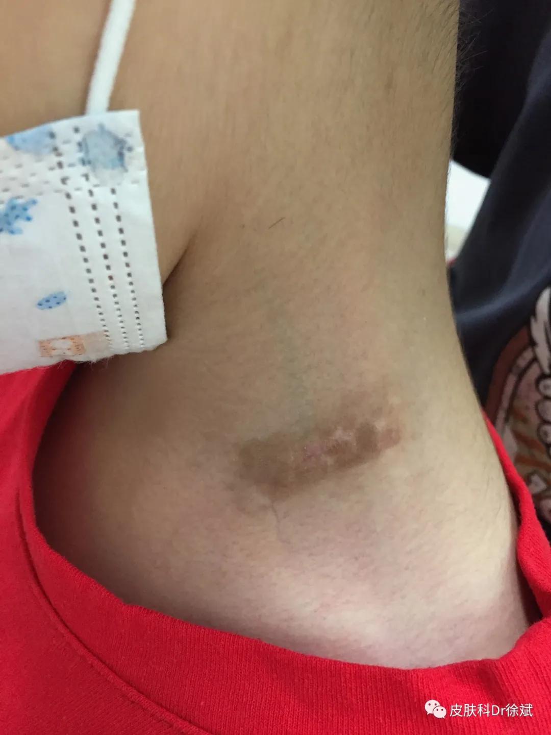 儿童治疗白癜风需要多少钱,uvb治疗白癜风多久见效