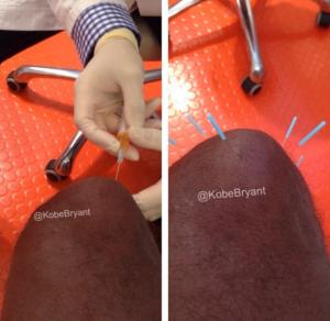 为什么干细胞成为治疗关节疼痛的最佳选择，来看看这些实例