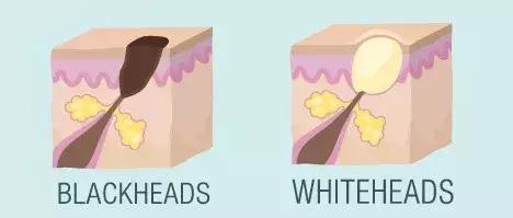 去黑头的方法你真的对了吗,盘点一下各种去黑头办法的优缺点