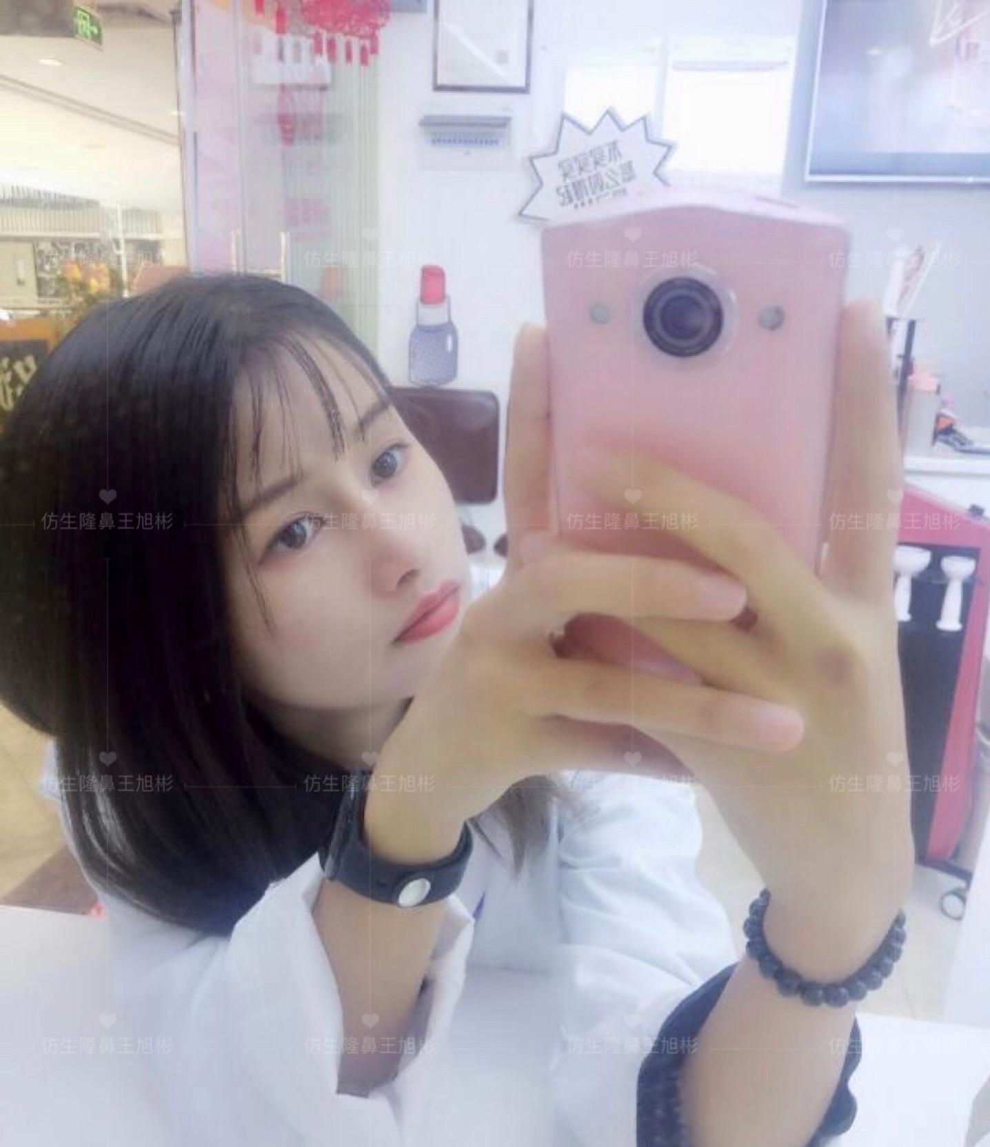 山根低鼻头大隆鼻,鼻根很低的隆鼻后的效果