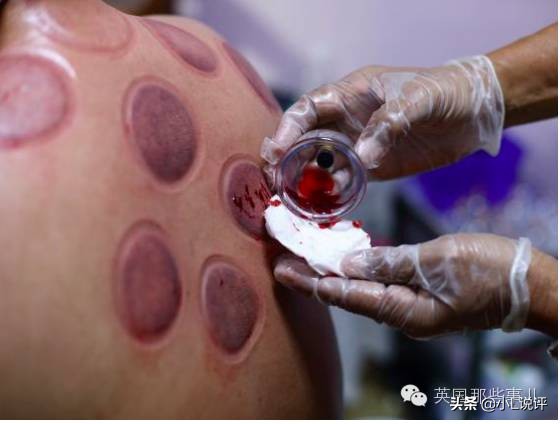 来自东方的神秘力量，让老外痴迷的拔火罐和蚊帐