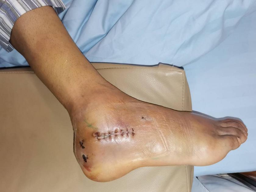 左股骨粗隆间粉碎性骨折微创手术,跟骨粉碎性骨折微创手术最快多久