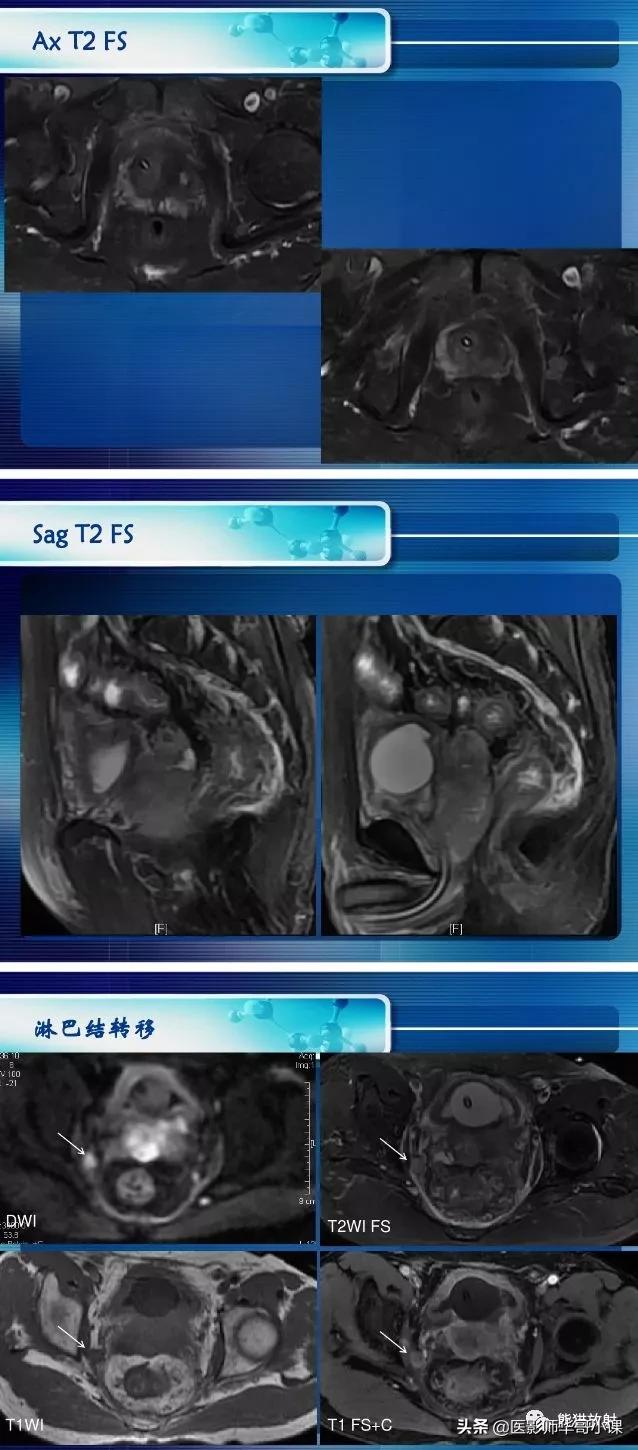 前列腺磁共振影像解剖,前列腺mri正常诊断报告模板