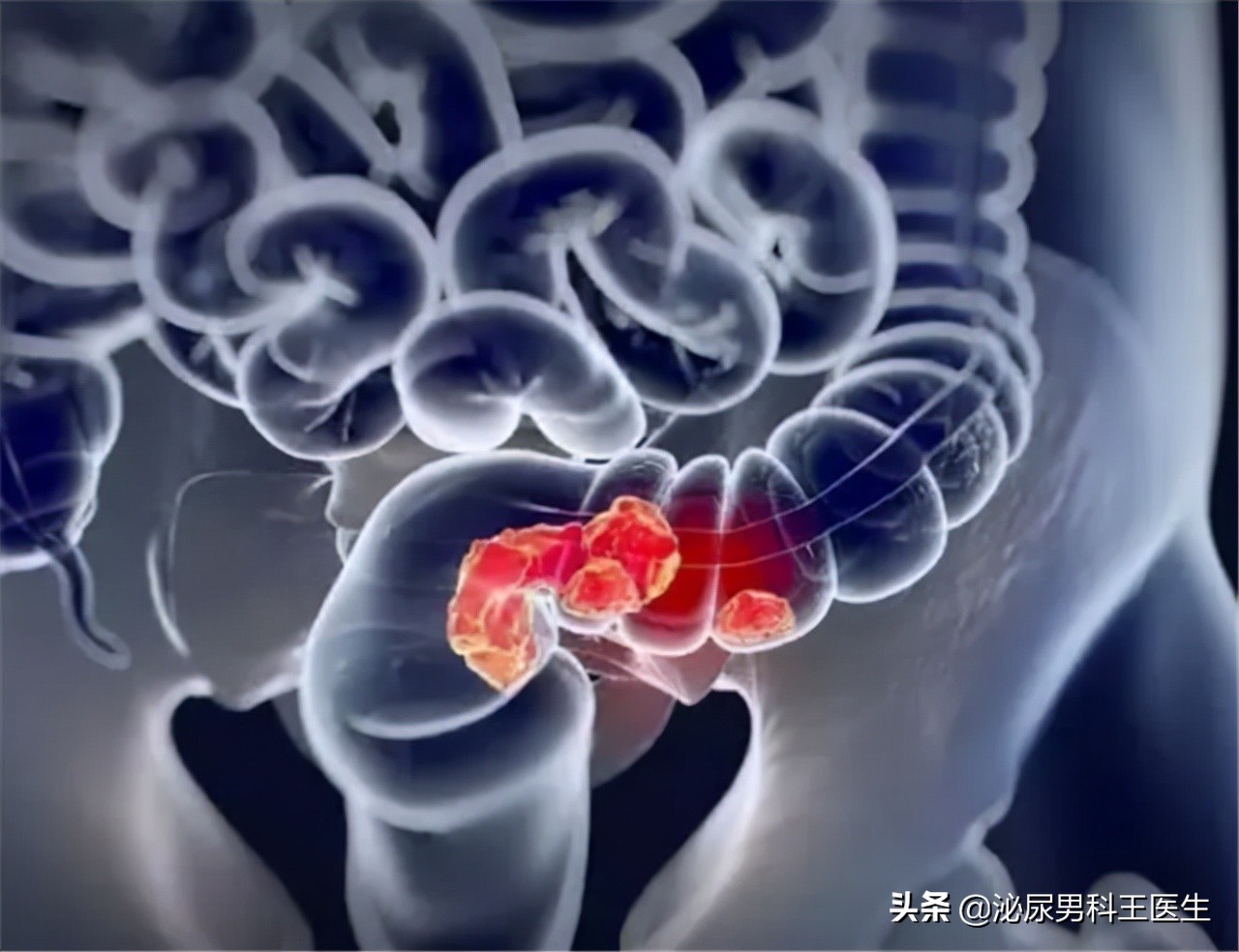 为什么年轻人会得前列腺癌,为什么年轻人会得前列腺炎