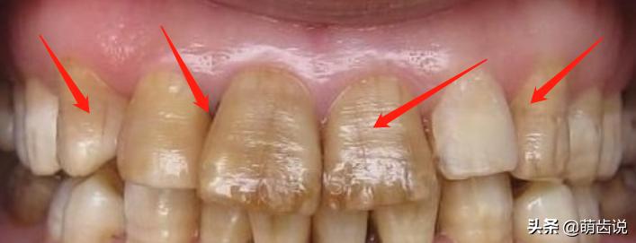 儿童应该选用儿童牙膏,这四种儿童牙膏千万别给孩子用了