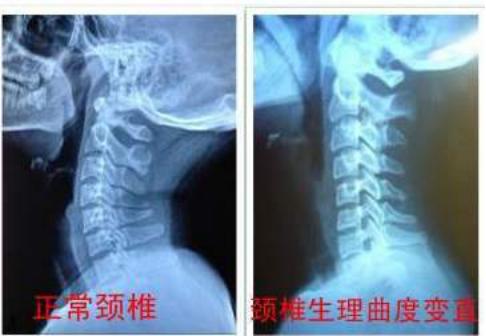 颈椎曲度变直正常生理曲度消失,颈椎曲度变直如何有效恢复