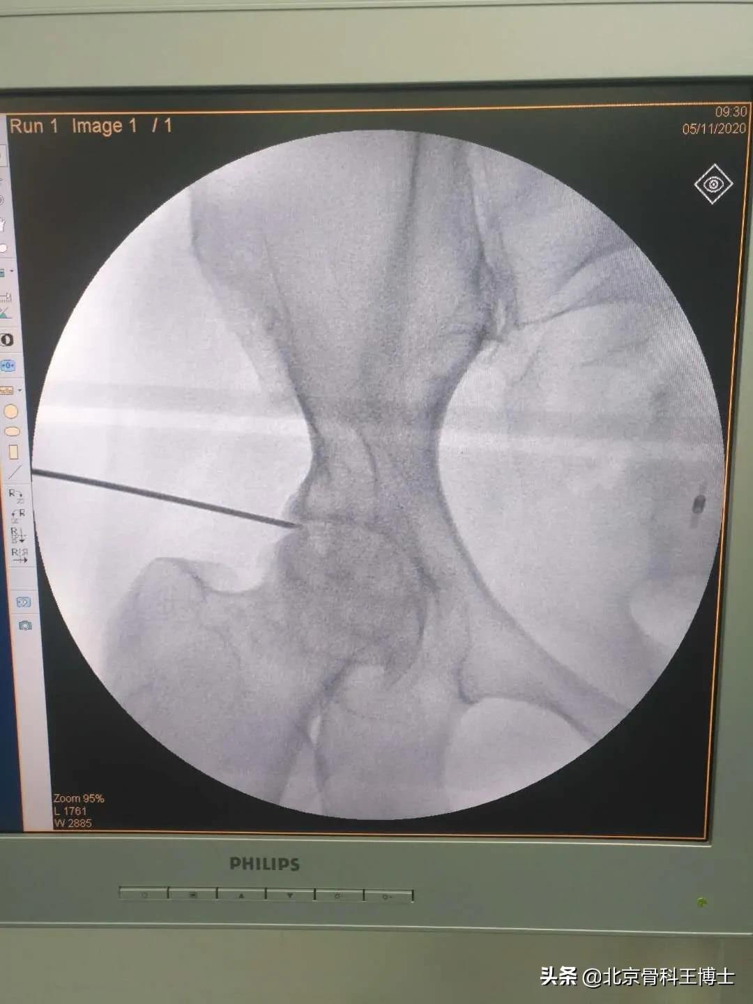 股骨头坏死,股骨头坏死前期锻炼能自愈吗
