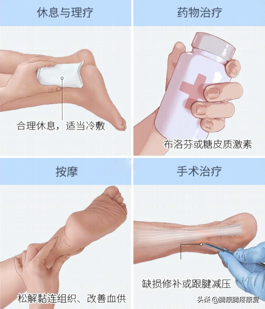 跟腱炎诊疗计划,跟腱炎四个痛点