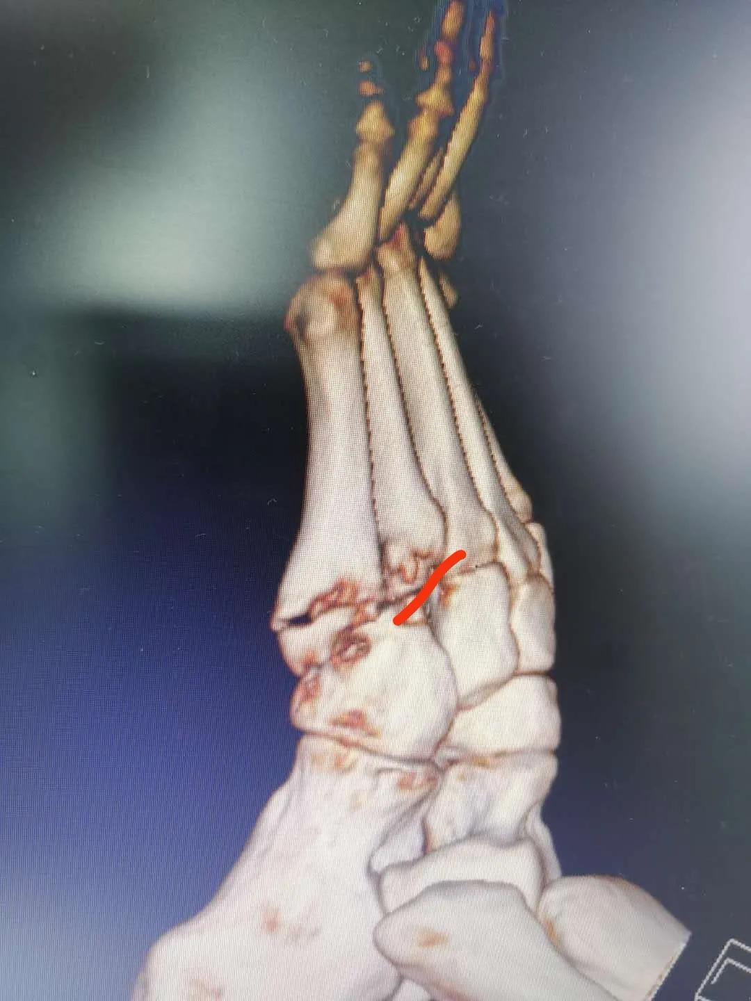 第五跖骨粉碎性骨折多久后能走路,第五跖骨基底骨折100天了走路肿