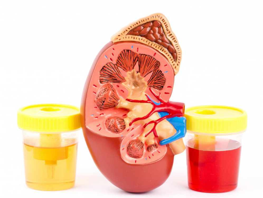 尿常规几项指标分别代表什么,尿常规肿瘤表现