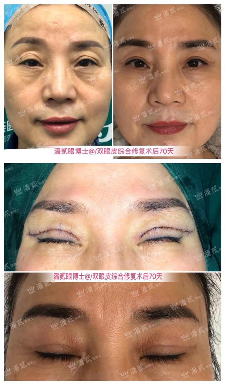 割了开扇双眼皮眼尾上扬太宽,眼尾上扬的眼睛适合什么双眼皮