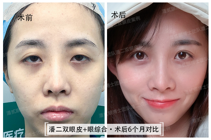 眼综合可以去掉抬头纹吗,眼综合抬头纹