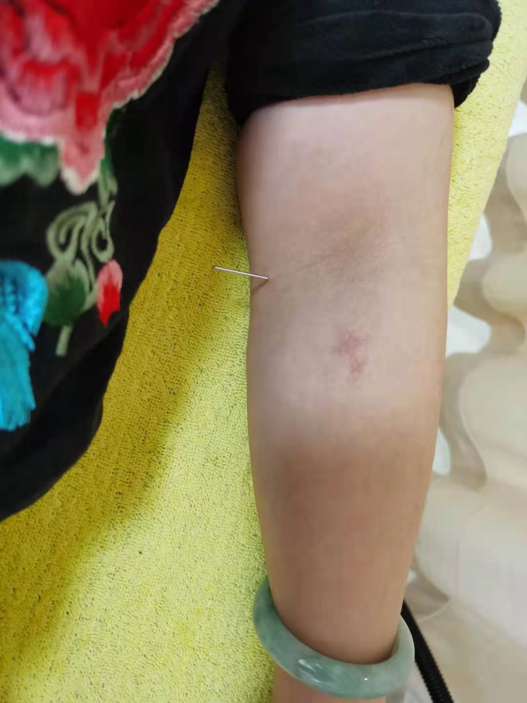 倪海厦失眠针灸案例,针灸治失眠的视频