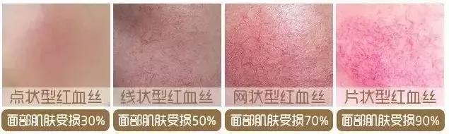 *血丝红**还有救吗？看完这篇你就知道啦